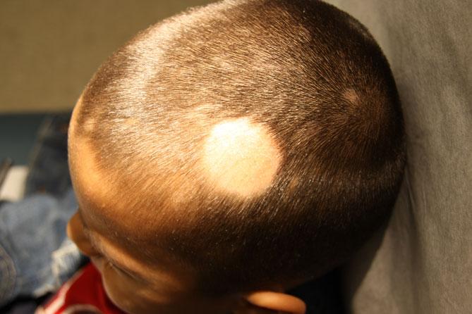 What causes alopecia and how can it be treated? - Vancouver Paramedical Clinic	