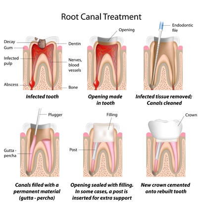 Root Canal with CEREC in McAllen, TX
