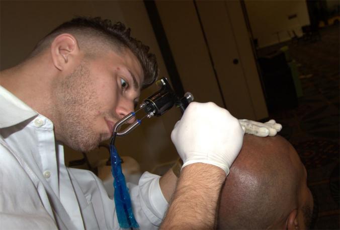 How much does scalp micropigmentation cost? - HairAdviceNetwork